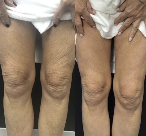 <p>Meer dan 45.000+ Vrouwen gingen je voor<br/><br/></p>